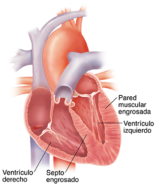 Corte transversal del corazón con paredes ventriculares gruesas.