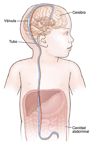 Vista frontal de un bebé con una derivación ventriculoperitoneal en el cerebro.