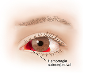 Vista frontal del ojo con hemorragia subconjuntival.