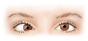 Vista frontal de los ojos de un adulto donde se observan un ojo mirando al frente y otro mirando hacia la nariz.
