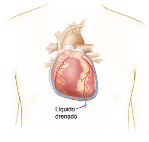 Vista frontal del pecho de una persona donde se observa el corazón y un corte transversal del pericardio. A través de un orificio en el pericardio, se drena el líquido extra.
