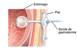 Corte transversal de cuerpo humano donde puede verse una sonda de gastrostomía introducida en el estómago.