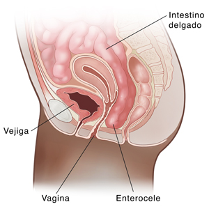 Vista lateral de corte transversal de la pelvis femenina donde se observa el prolapso de intestino delgado (enterocele).