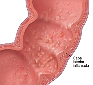 Corte transversal de un segmento del colon sigmoide con enfermedad inflamatoria.