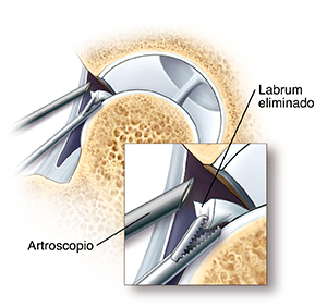 Corte transversal de una articulación de cadera en donde se ven instrumentos artroscópicos que extraen las partes sueltas del labrum. Primer plano de la punta de un artroscopio en una articulación de cadera; se ve un instrumento que quita parte del labrum.